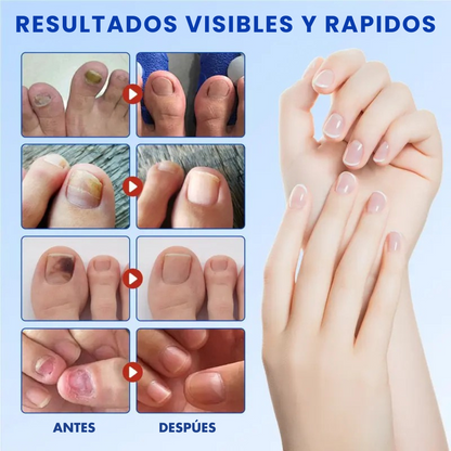 FungalNail™ 21 Parches Antihongos | 2x1